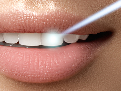 Laser dentistry, Kary Dental